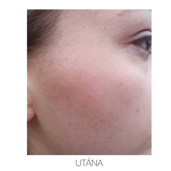 ACNE CONTROL tengeri algás pórustisztító gél 100ml - Image 3