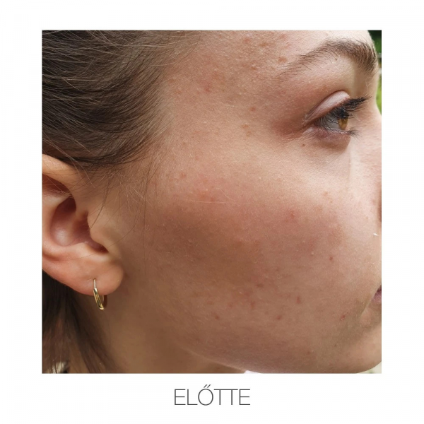 ACNE CONTROL tengeri algás pórustisztító gél 100ml - Image 2